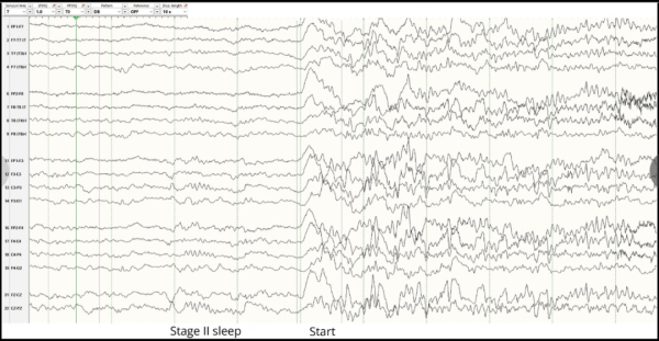红腾网配资 离谱！小伙一晚上发作30次癫痫，这个药一用效果立竿见影，究竟是怎么回事？